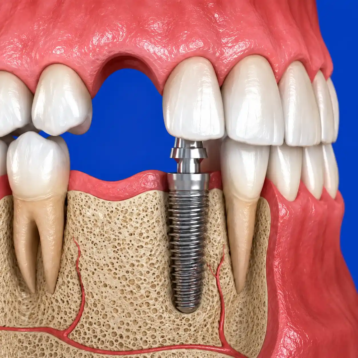 Implantologia-cuneo Illustrazione arcata dentale con impianto, vite visibile nell'osso mascellare