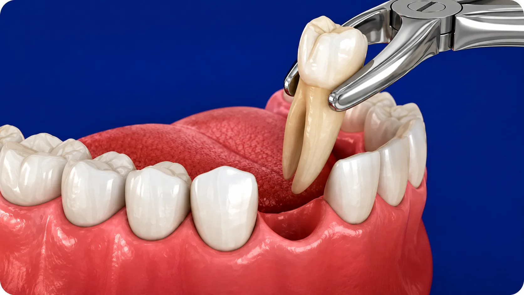 chirurgia-orale-estrazione-dente-studio-dentistico-favro-cuneo Dente estratto dall'arcata mediante pinza odontoiatrica durante una procedura di chirurgia orale