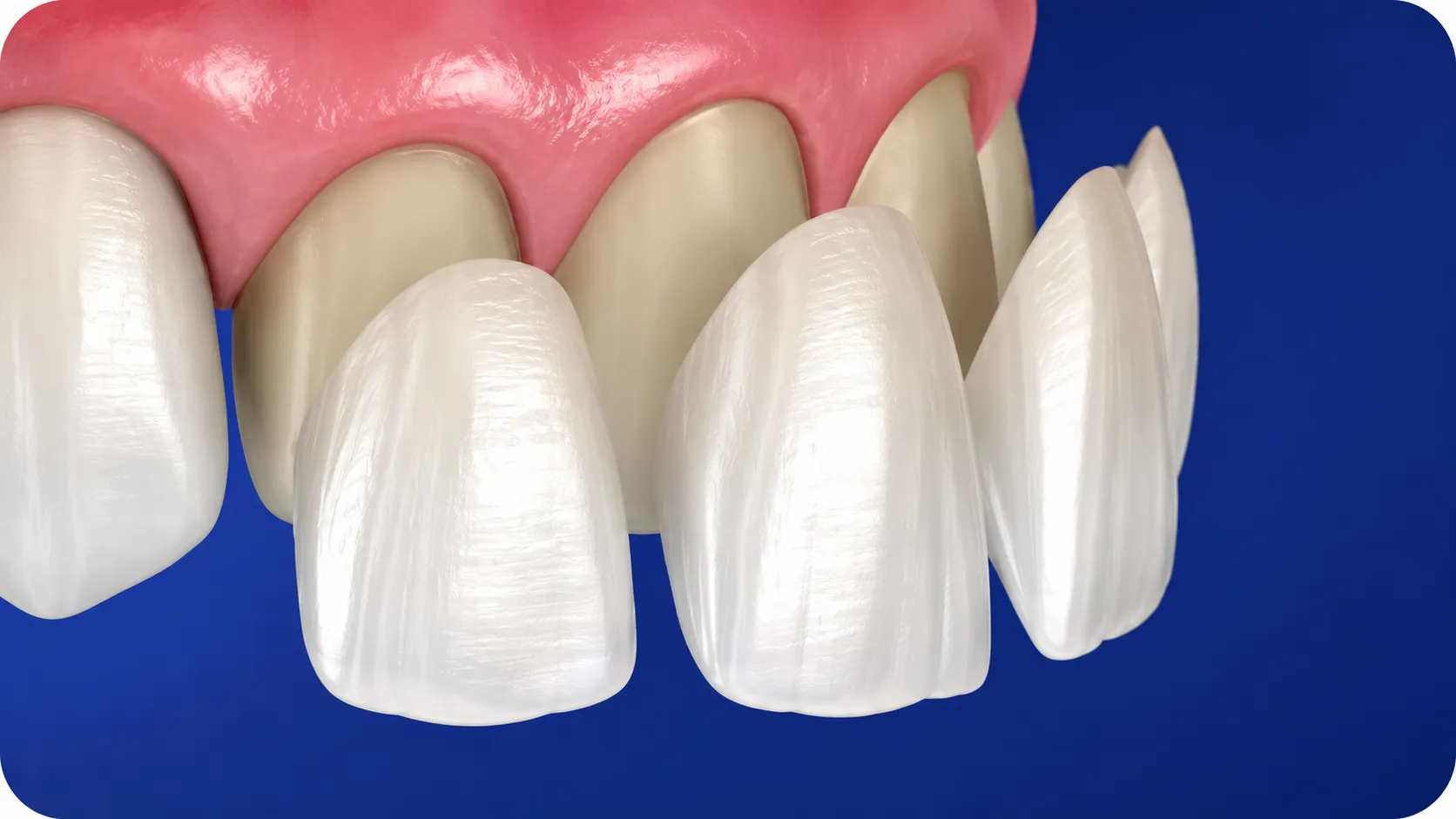 estetica-dentale-faccette-studio-dentistico-favro-cuneo Dente estratto dall'arcata mediante pinza odontoiatrica durante una procedura di chirurgia orale