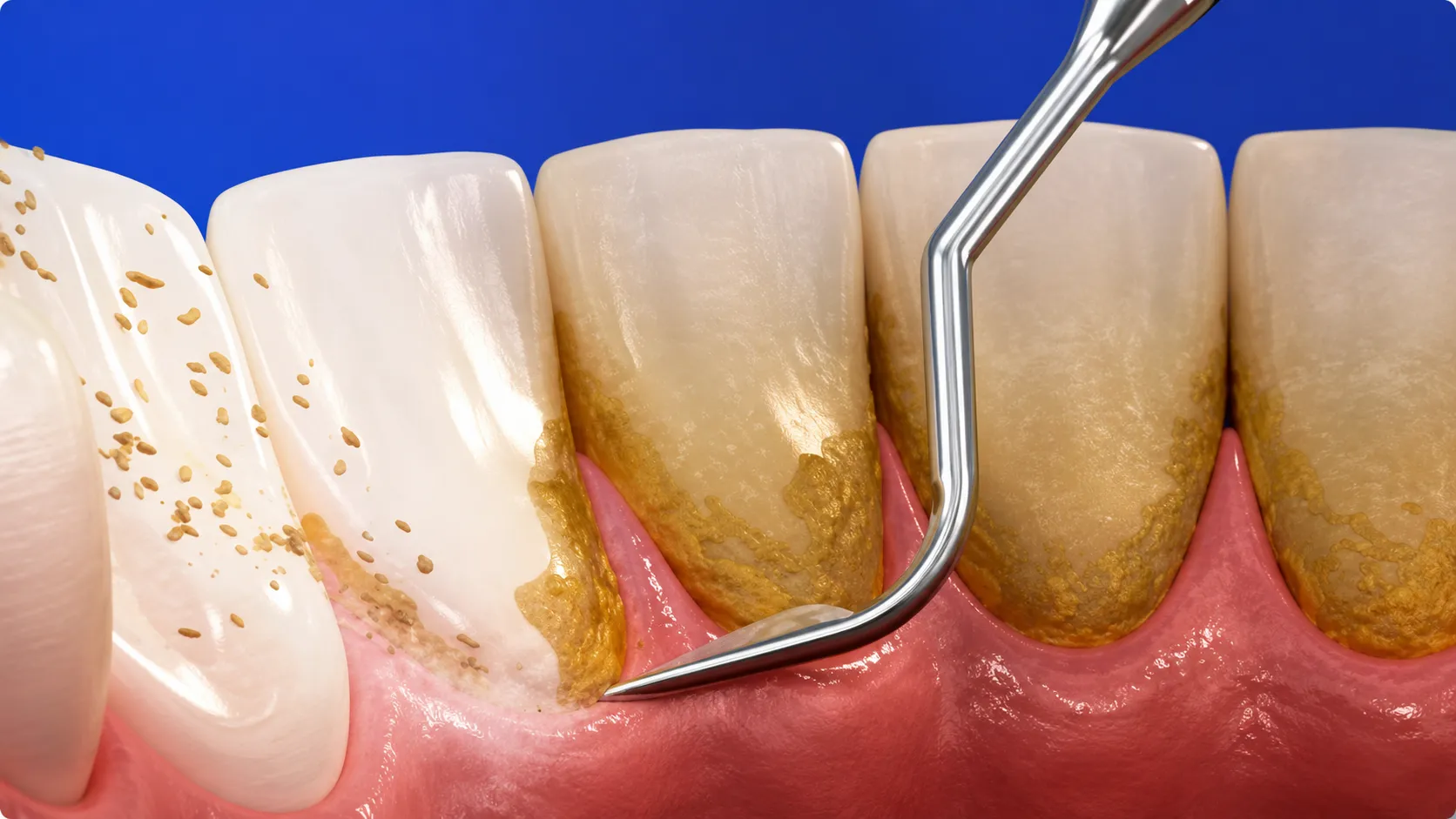 igiene-prevenzione-dentale-studio-dentistico-favro-cuneo Eseguiamo devitalizzazioni e ritrattamenti canalari per eliminare dolore e infezioni, preservando il dente naturale ogni volta che è possibile.