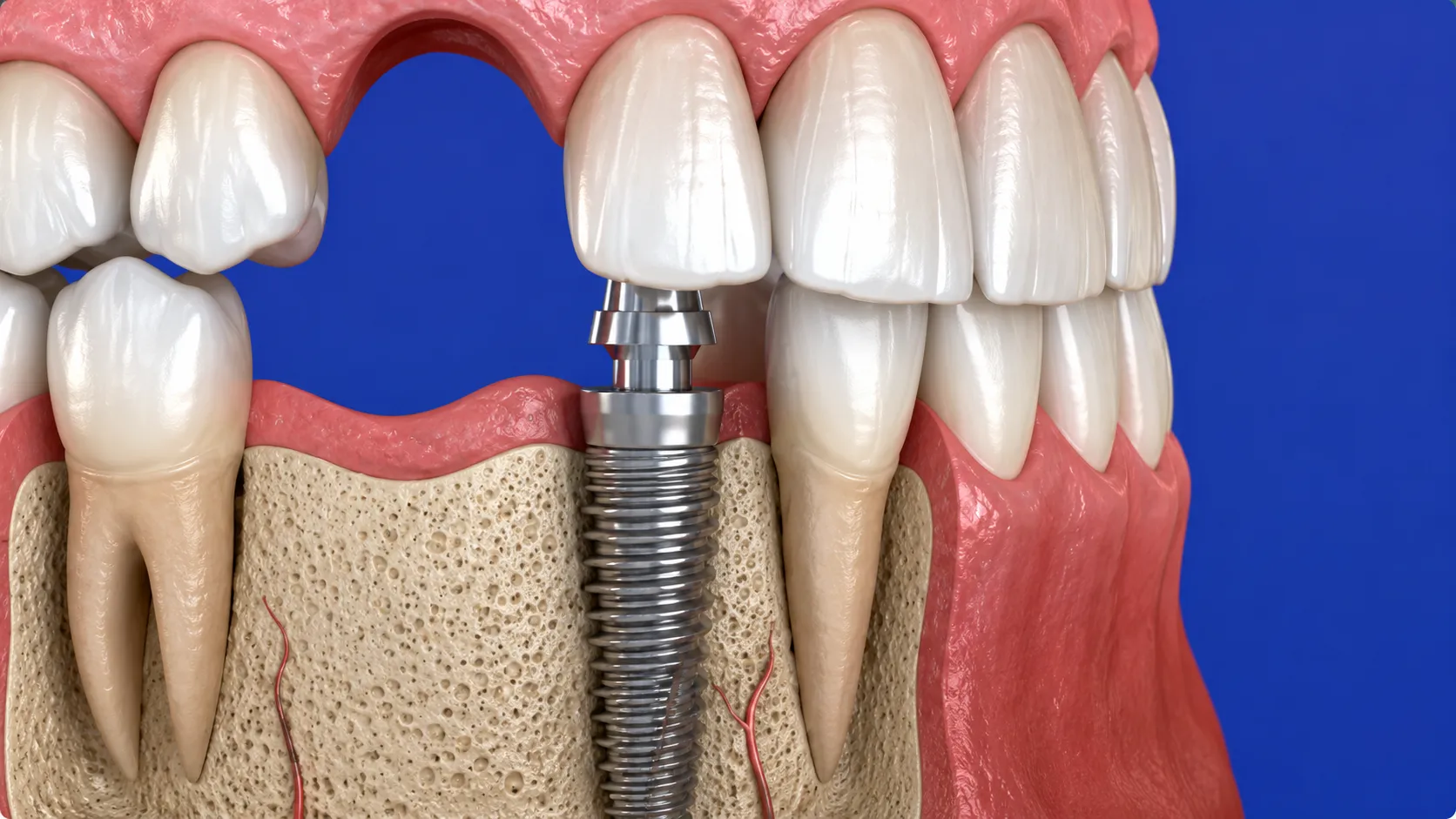 implantologia-impianto-dentale-studio-dentistico-favro-cuneo Impianto dentale inserito nell'osso mandibolare per sostituire un dente mancante