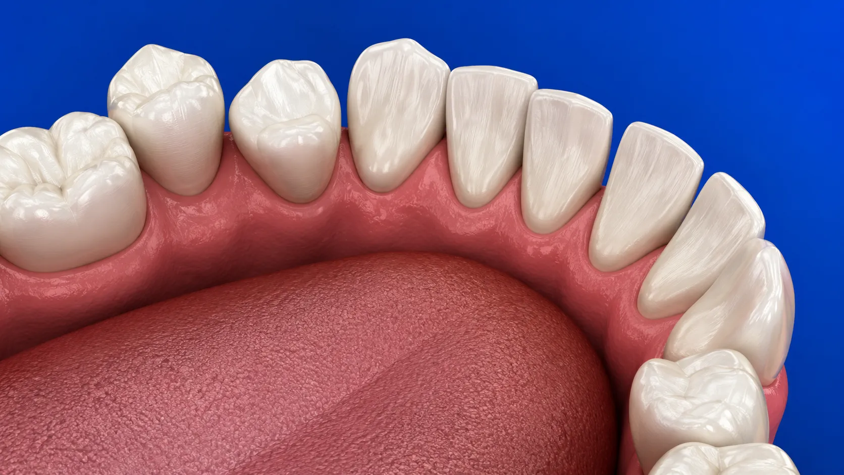 ortodonzia-allineamento-denti-studio-dentistico-favro-cuneo Arcata dentale inferiore con denti disallineati e affollati rappresentata prima di un trattamento ortodontico