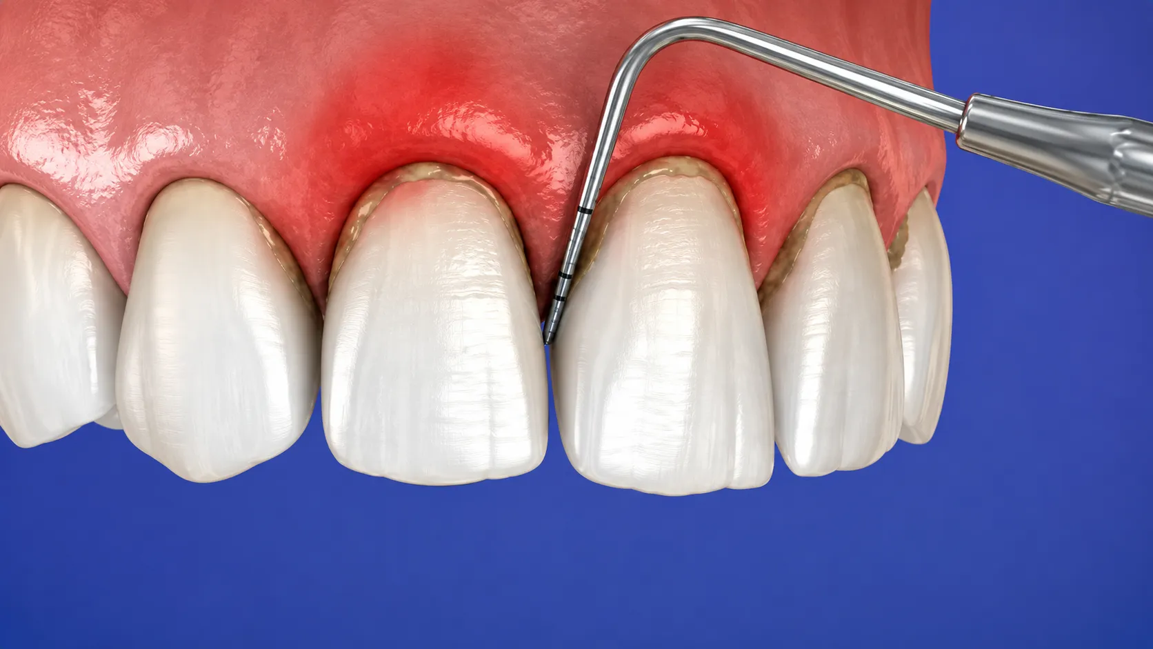 -parodontologia-trattamento-gengive-studio-dentistico-favro-cuneo Sonda parodontale inserita tra dente e gengiva per la valutazione della salute gengivale e dei tessuti parodontali