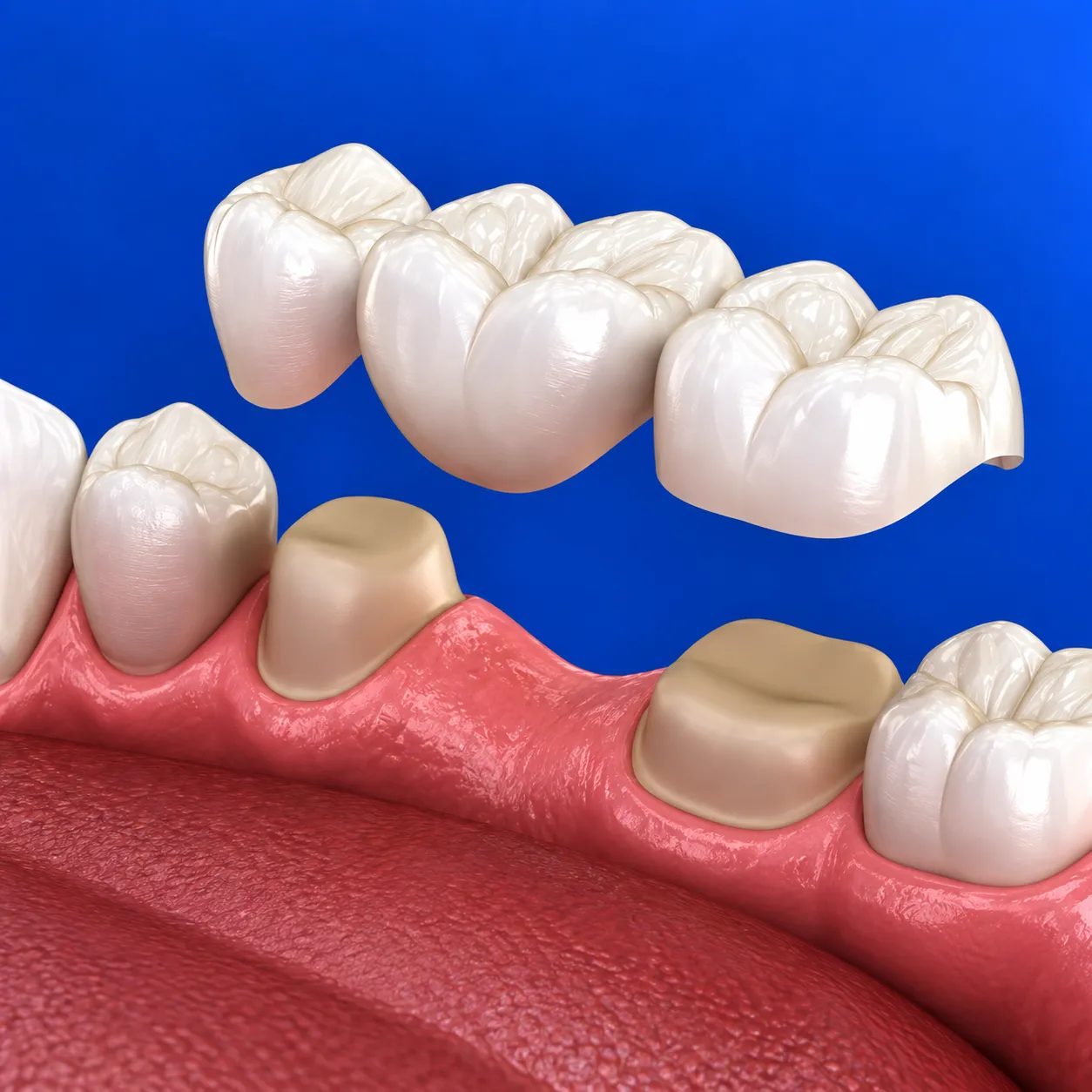 protesi-dentali-cuneo illustrazione di arcata dentale con dente mancante e protesi dentale fissa sospesa nell'atto di inserirla nell'arcata dentale
