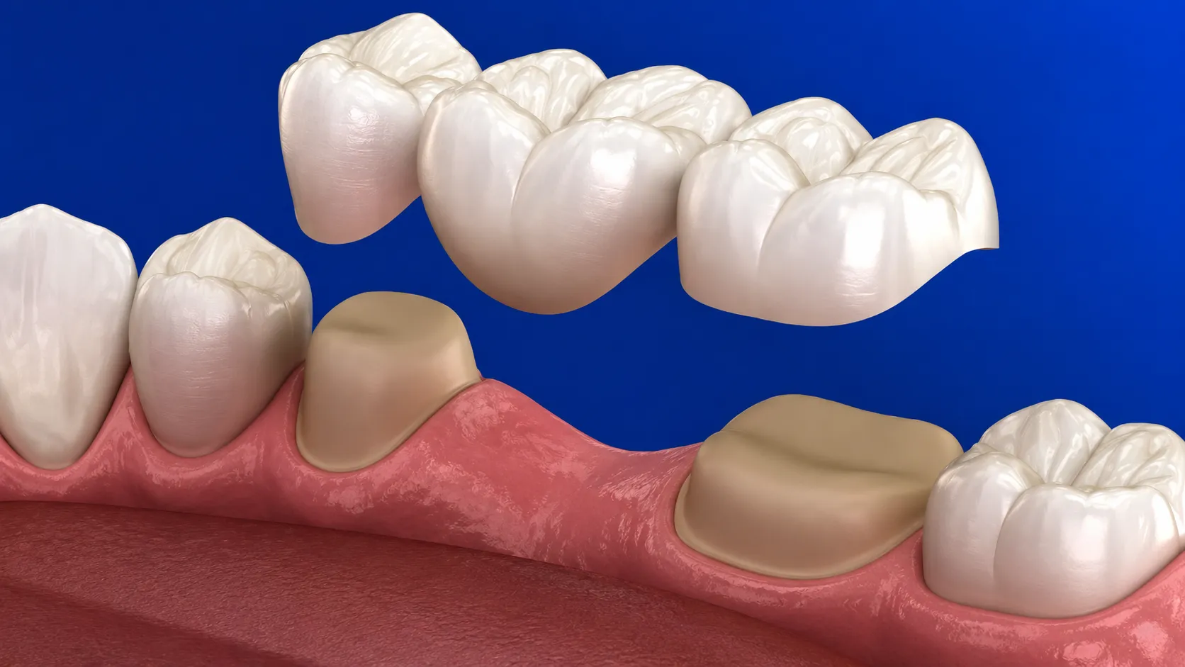 protesi-dentali-ponte-studio-dentistico-favro-cuneo Ponte dentale composto da più corone posizionato sopra denti preparati per ripristinare elementi dentali mancanti